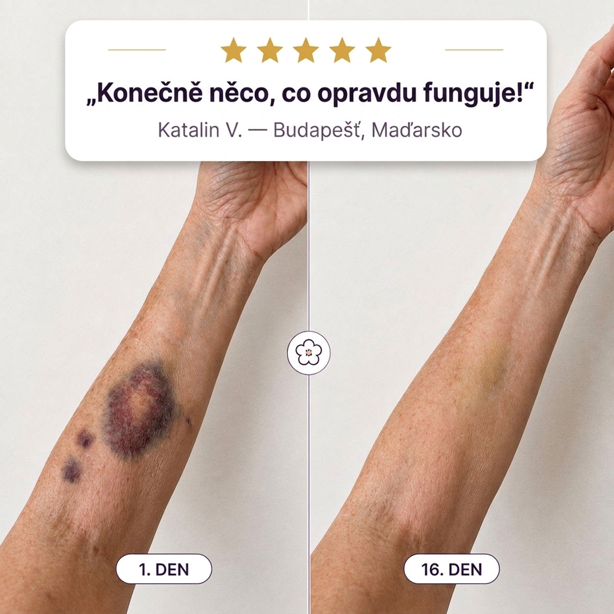 PuraCure® Krém na starostlivosť o modriny a posilnenie pokožky – pre zrelú, tenkú a krehkú pokožku
