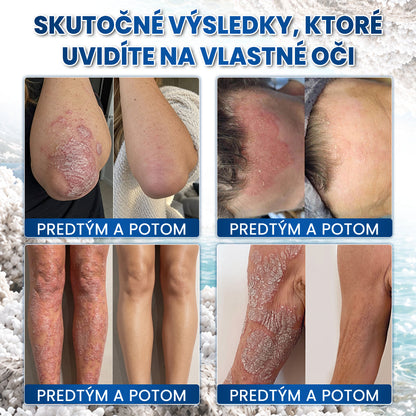 🌿Medistart® ŠPECIÁLNA STAROSTLIVOSŤ O POKOŽKU PRI PSORIÁZE