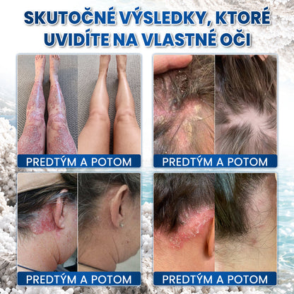 🌿Medistart® ŠPECIÁLNA STAROSTLIVOSŤ O POKOŽKU PRI PSORIÁZE