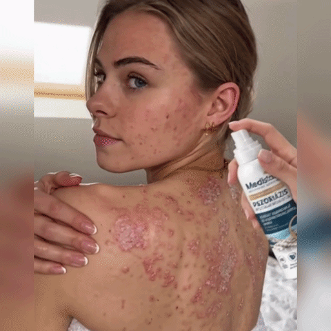 🌿Medistart® ŠPECIÁLNA STAROSTLIVOSŤ O POKOŽKU PRI PSORIÁZE